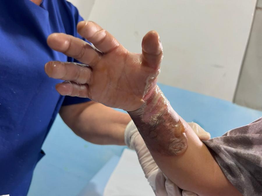 Mãe queima filha após desentendimento com companheiro em Itamari